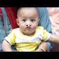 Rare Bilateral Cleft Baby from Bangladesh – Before Surgery Consultation