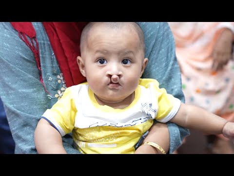 Rare Bilateral Cleft Baby from Bangladesh – Before Surgery Consultation