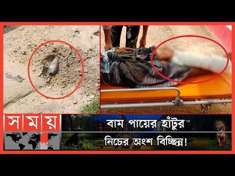 এবার মিয়ানমারের মাইনে উড়ে গেল বাংলাদেশি যুবকের পা! | Myanmar-Bangladesh Conflict | Somoy TV