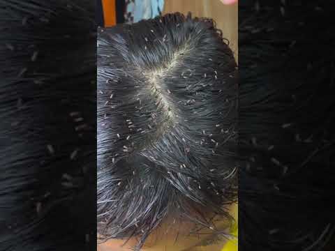 Picking a thousand of lice on hair – How to remove lice